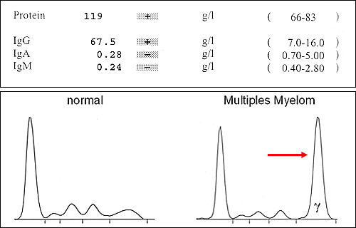 Myelom mit M-Gradient in der Eiweißelektrophorese
